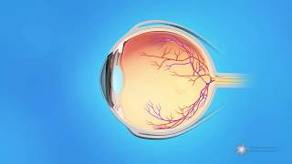 What causes a retinal tear or detachment?