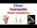 Ulnar Neuropathy (& Numbness in the Hand) | Causes, Signs & Symptoms, Diagnosis, Treatment