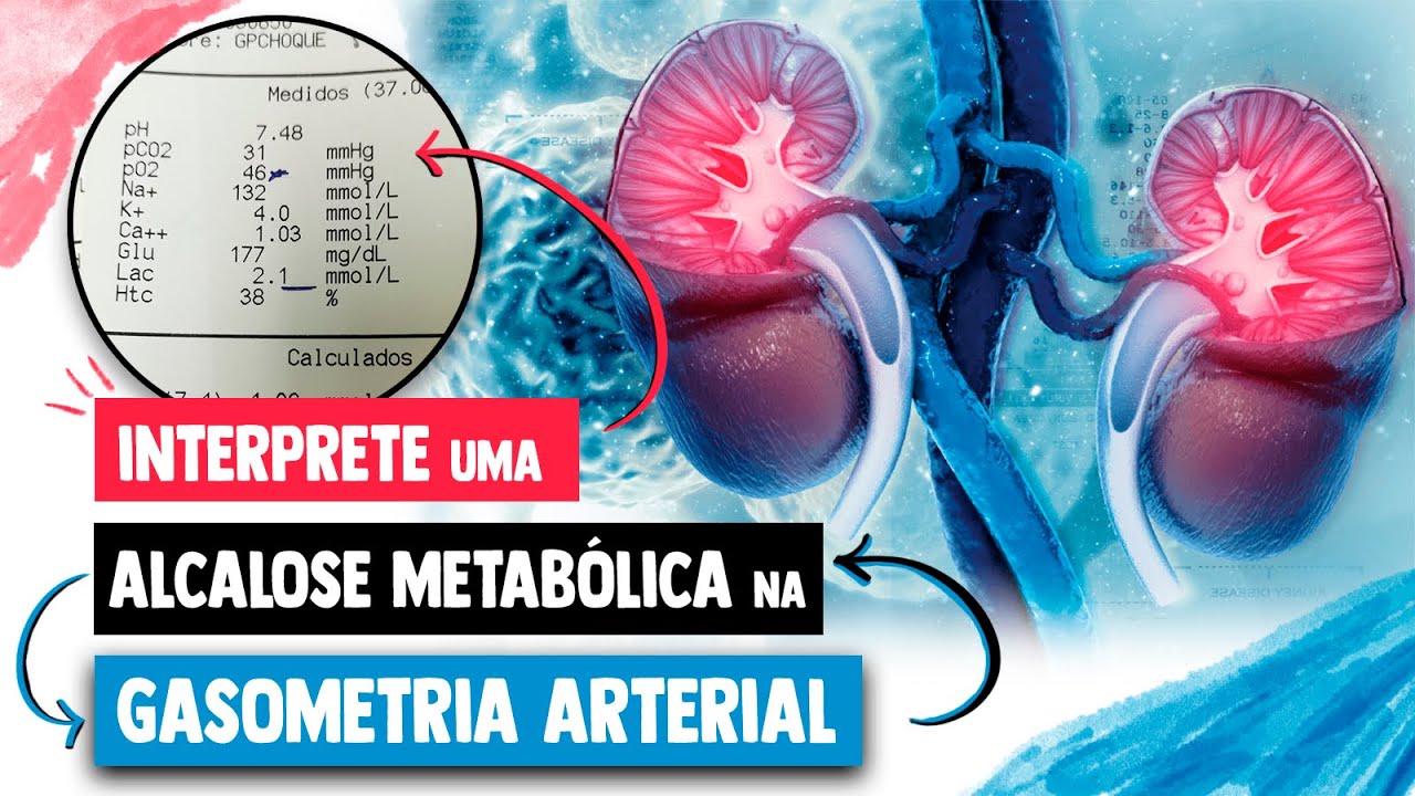 GASOMETRIA ARTERIAL de uma ALCALOSE METABÓLICA │ Medicina Resumida