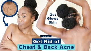 Summer Glowy Skincare Routine | Get Rid of Chest & Back Acne, Boils & Cysts | Affordable & Cheap