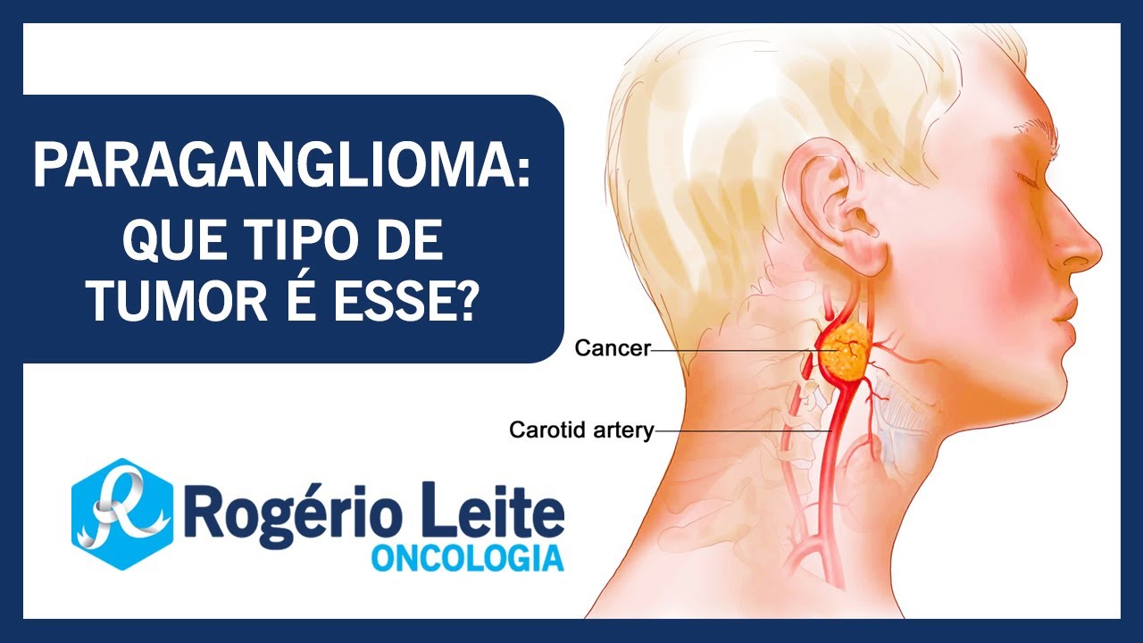 Paraganglioma: que tipo de tumor é esse? | Dr. Rogério Leite
