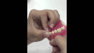 Periodontal Splinting (Discontinuous)