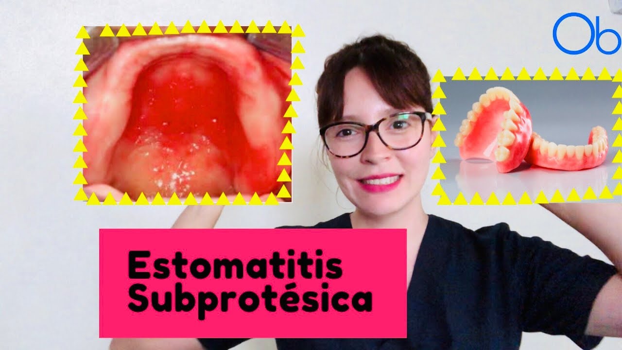 ESTOMATITIS SUBPROTÉSICA