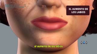 Relleno Facial Ácido Hialurónico - María Clara Mejía Escalante