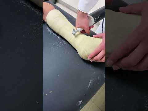 How to Safely Remove a Fiberglass Cast from an Ankle Fracture: Expert Tips & Patient Care