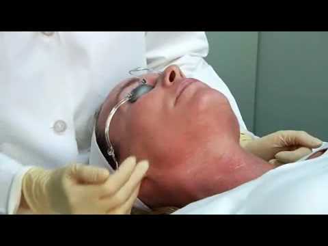 Klotrimazol e posti di pigmentary Candeggiare pigmentary nota il succo di limone