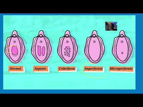 Mucocolpos in imperforate hymen; membrane is seen as a shiny, thin bulge