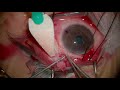 Surgery: Baerveldt Glaucoma Implant