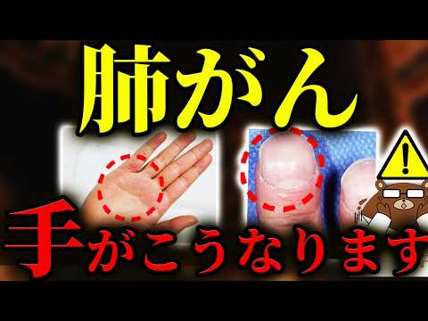 【超意外な初期症状】放置厳禁！知らないと後悔する肺がんの「手」の危険サイン。指の形.手首の腫れ掌の変化..意外な兆候とは？五十肩だと思ったらまさかの..肺がんに予防法はあるのか？医師が徹底解説。