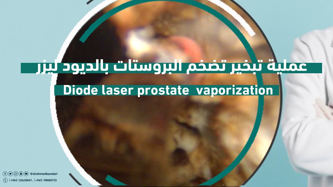 عملية تبخير تضخم البروستات بالديود ليزر . Diode laser prostate vaporization