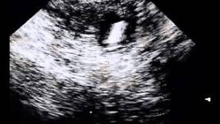 Ultrasonido de captura ovular - Ginecólogos del Sur