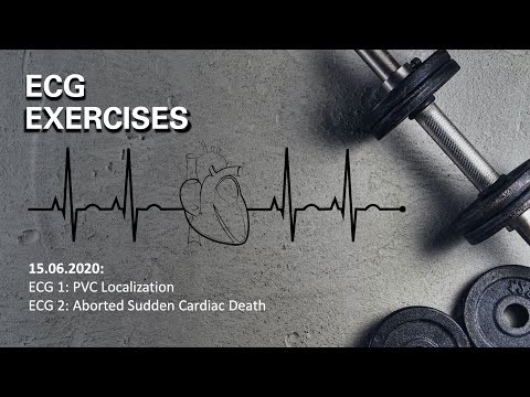 ECG Exercises from 15 06 2020: ECGs and Discussion