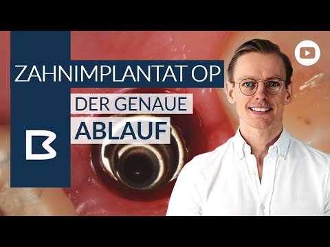 Zahnimplantat OP - Der genaue Ablauf