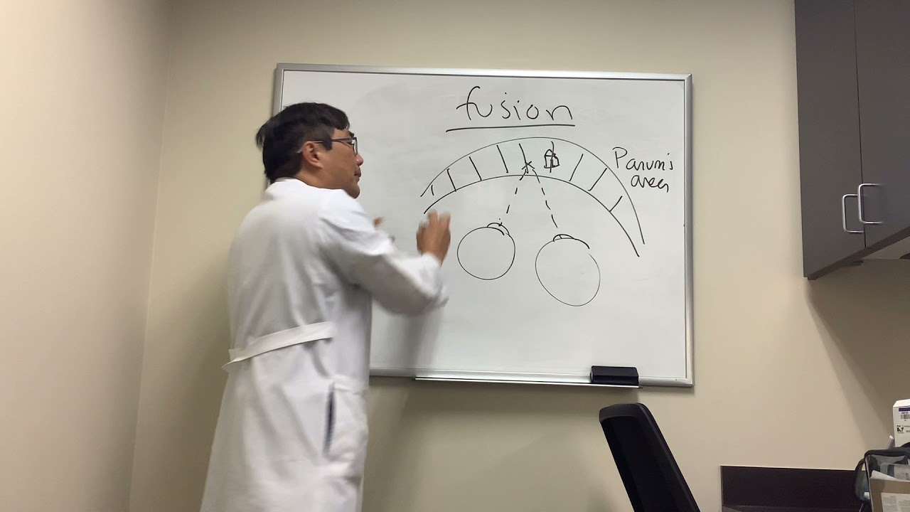 Fusion and Binocular vision