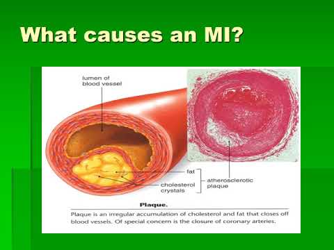 Myocardial Ischemia and Infarction
