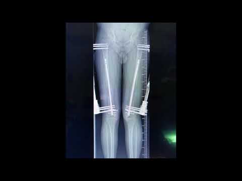 Our Limb Lengthening Patients Image Compilation wannabetaller.com