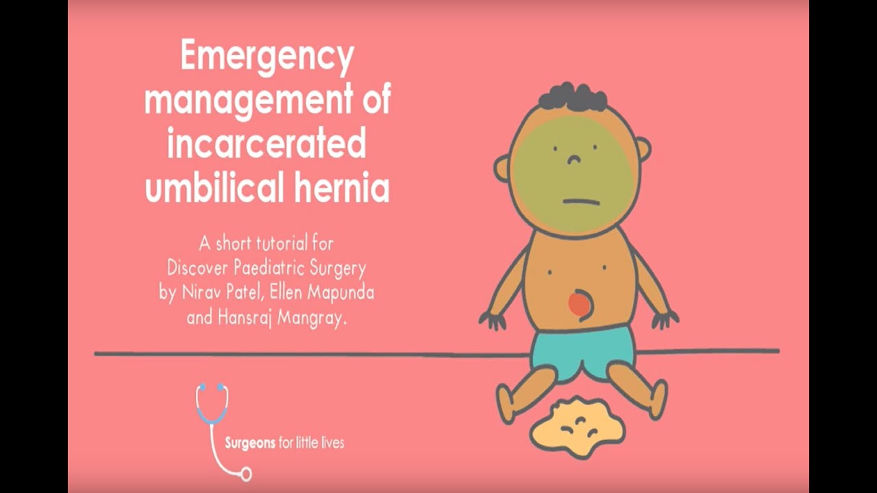 Emergency Management of Incarcerated Umbilical Hernia