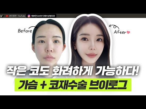 복코 재수술과 가슴성형으로 이제는 당당해요!ㅣ성형 브이로그ㅣ디에이성형외과