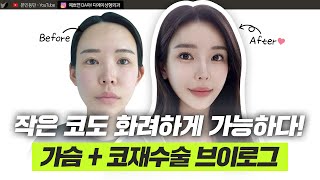 복코 재수술과 가슴성형으로 이제는 당당해요!ㅣ성형 브이로그ㅣ디에이성형외과
