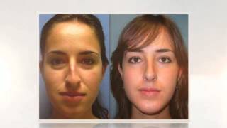 (855) 622-4466 Nose Job Prices Plastic Surgery Omaha NE | Rhinoplasty Surgery Prices Nebraska