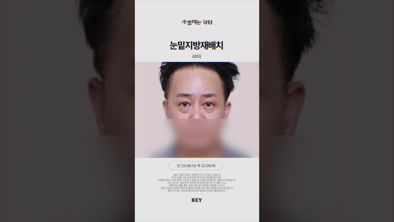 60대 눈밑지방재배치 대구키성형외과