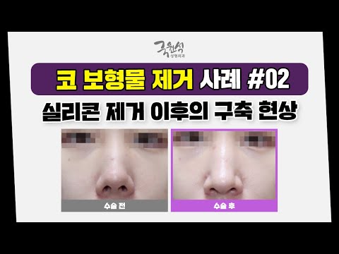 부작용 때문에 실리콘"만" 제거하려 하셨나요❓❗