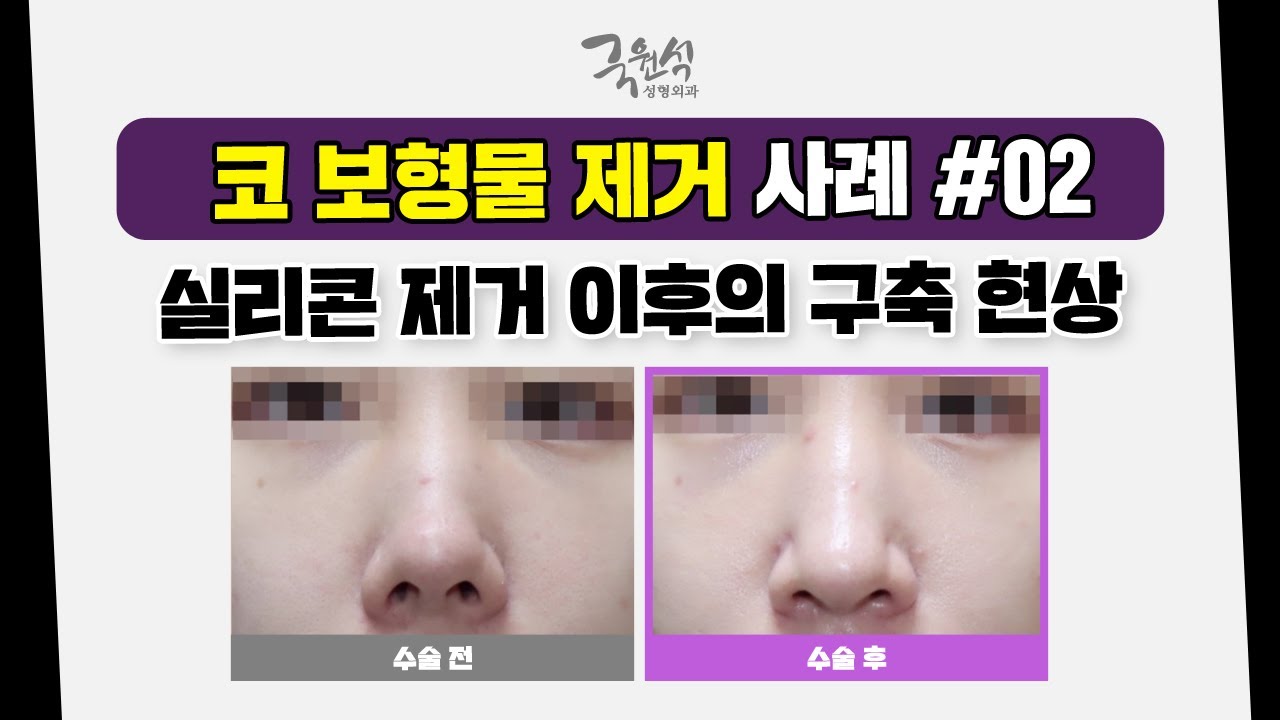 부작용 때문에 실리콘"만" 제거하려 하셨나요❓❗