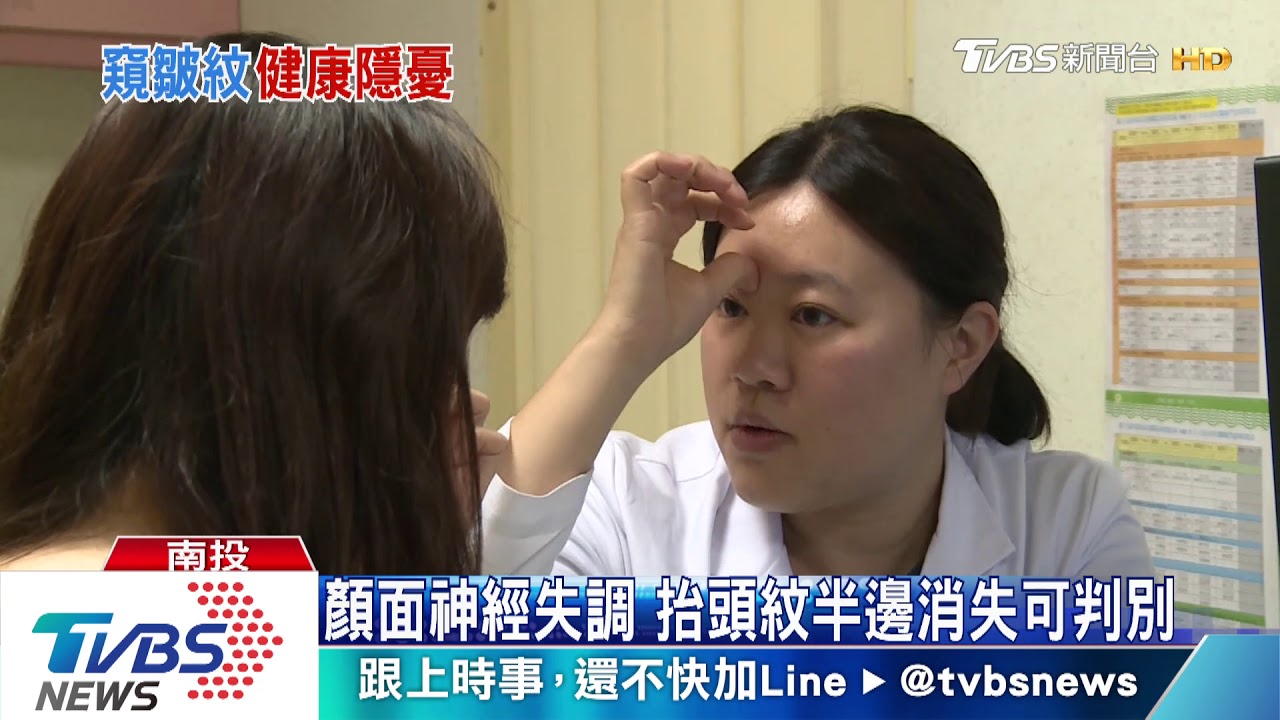 顏面神經失調 抬頭紋半邊消失可判別