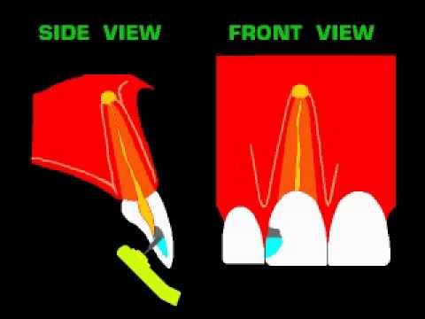Root Canal Treatment- in hindi