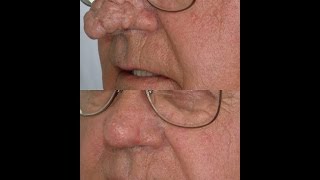 Treatment of Rhinophyma (swollen rosacea nose)