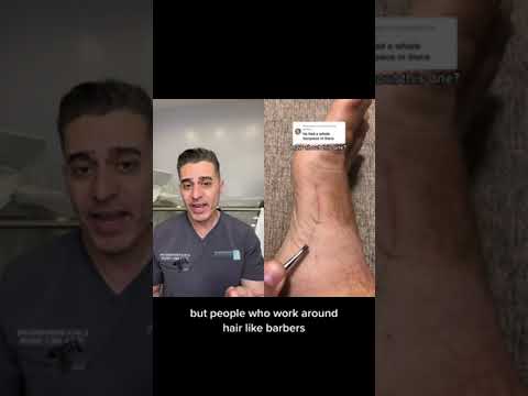 Doctor React To Hair Splinter In Foot!