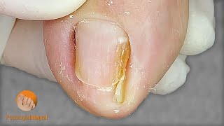 Toenail clipping to release and correct the lateral edges ensuring the patient's well-being