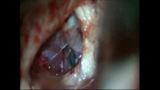 preview picture of video 'Brain tumor-craniophryngioma-microsurgical removal-dr suresh dugani/HUBLI/KARNATAK/INDIA'