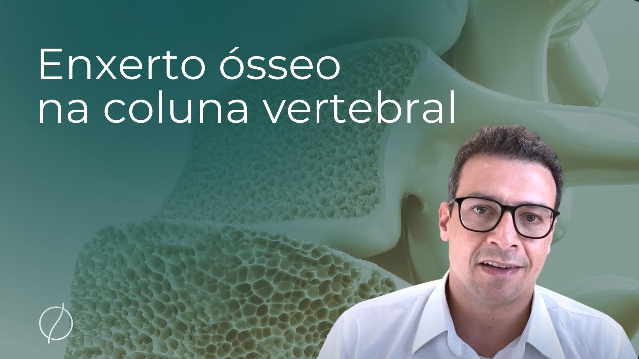 Enxerto ósseo na coluna vertebral - Prof. Dr. Alberto Gotfryd - Médico Especialista em Coluna.