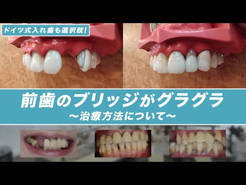 前歯のブリッジがグラグラ 〜治療方法について ドイツ式入れ歯も選択肢！〜