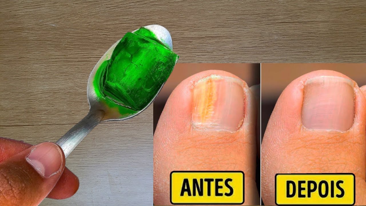 MORRIA E NÃO SABIA: Melhor receita caseira para eliminar micose de unha e acabar com fungos
