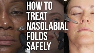 How to inject the nasolabial fold and avoid complications
