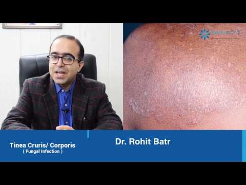 Watch this if you are suffering from Fungal Infection| Dr Rohit Batra