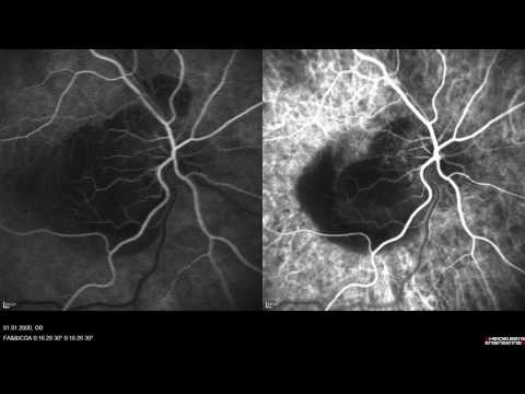 SPECTRALIS FA ICGA Simultan