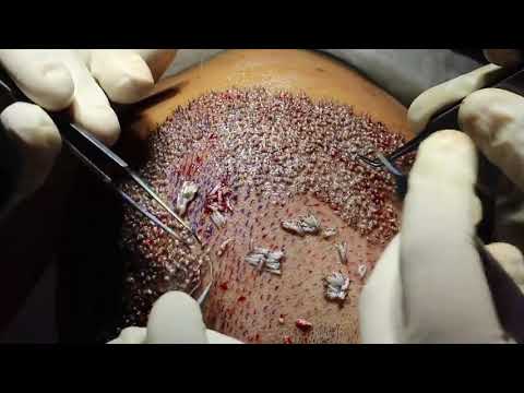 download lagu mp3 mp4 High Density Hair Transplant, download lagu High Density Hair Transplant gratis, unduh video klip High Density Hair Transplant