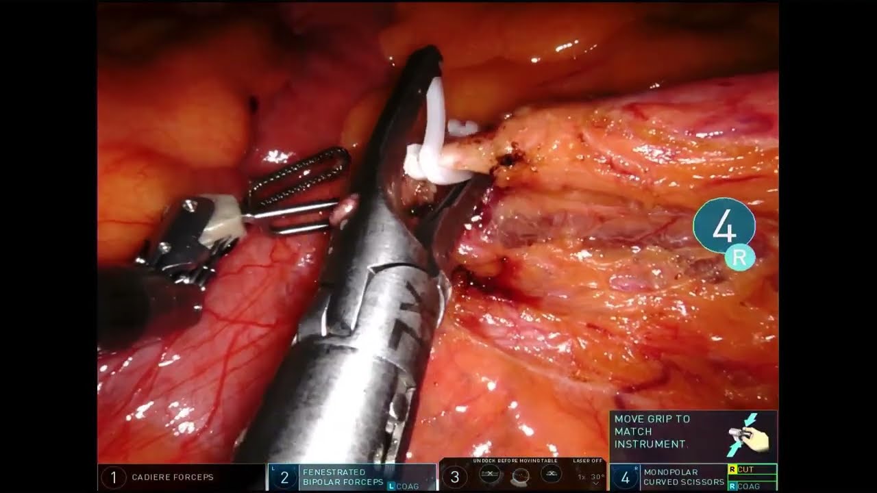 Robotic Anterior resection - colorectal surgery