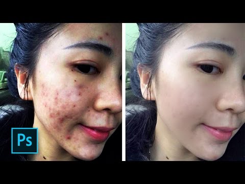 download lagu mp3 mp4 Cara Menghilangkan Jerawat Lewat Photoshop, download lagu Cara Menghilangkan Jerawat Lewat Photoshop gratis, unduh video klip Cara Menghilangkan Jerawat Lewat Photoshop