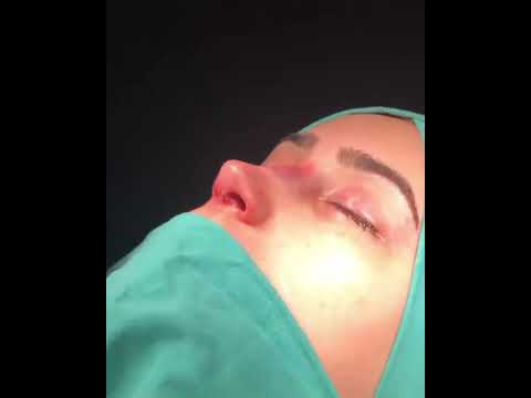 Op. Dr. Ayşe Karakaya | Eskişehir Nose Aesthetics | #Rhinoplasty #NoseAesthetics #Discover #HealthTourism