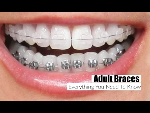 Adult Braces, Everything You Need To Know!-  MissLizHeart Video