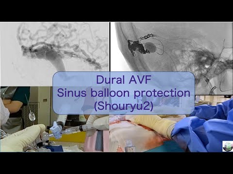 硬膜動静脈瘻ONYX塞栓 サイナスバルン (Shouryu2) Dural AVF sinus balloon protection