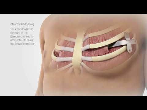 Pure Pectus - raising the bar in pectus repair