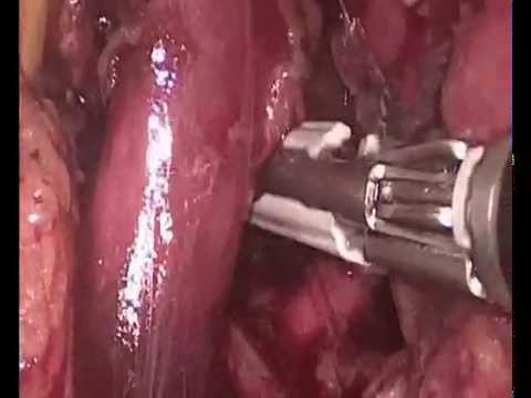 Pure Laparascopic Donor Nephrectomy in Azerbaijan