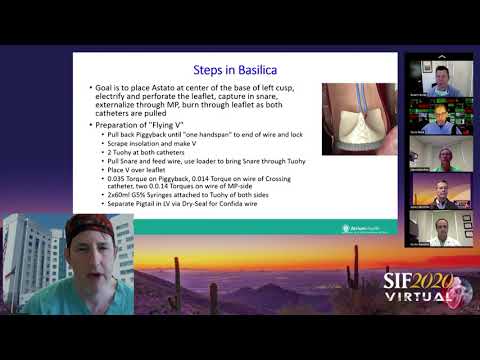 Valve in Valve TAVR; Navigating the Most Complex Anatomy Case Review