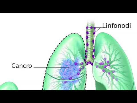 Con diagnosi di osteocondrosi del lombosacrale Riabilitazione del infortunio al gomito