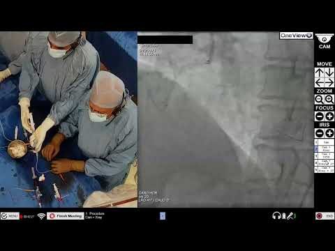 PCI Restenosis CTO RCA